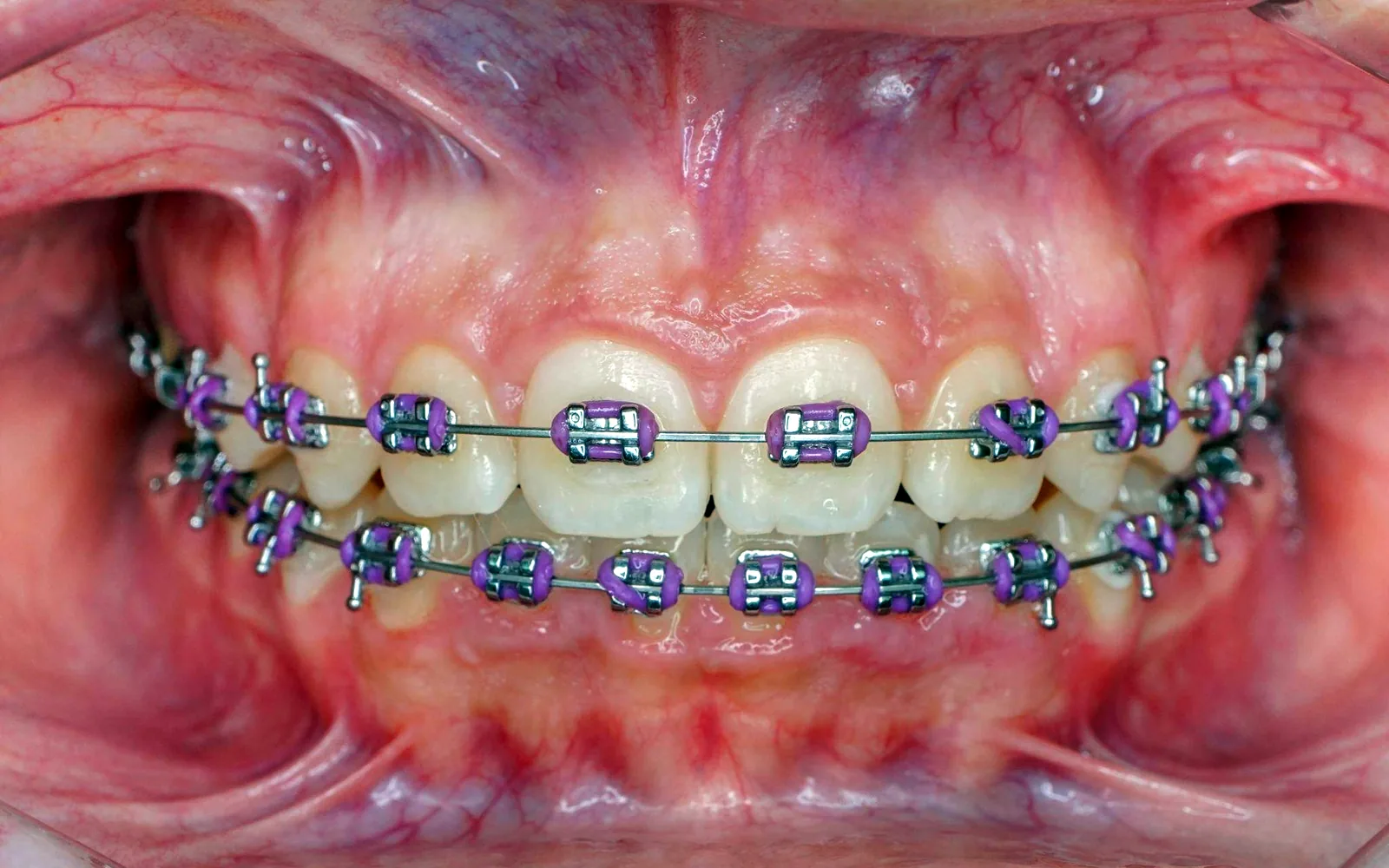 Avance del tratamiento con brackets